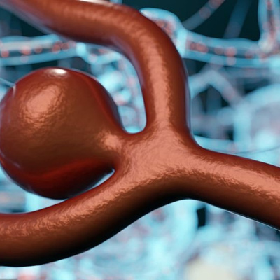 Recent Advances in the Treatment of Intracranial Hemorrhage: Multidisciplinary Cerebrovascular CME